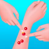 Прыщ Поппер Раш